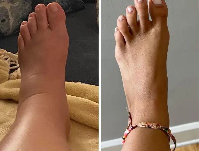 Kund använder NordHeal Circulation Pro