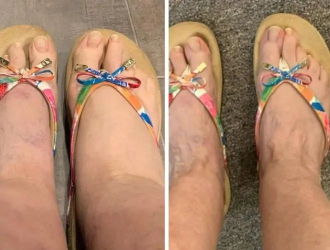 Före- och efterresultat med NordHeal